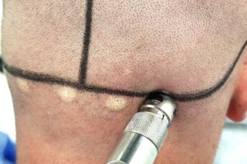 Does Hair Transplantation Cause Pain?
