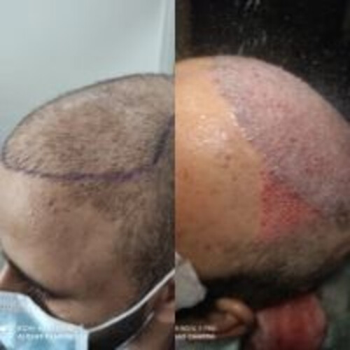 Can Failed Hair Transplantation Be Corrected?