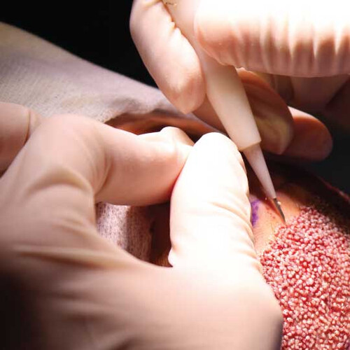 Direct Hair Transplant