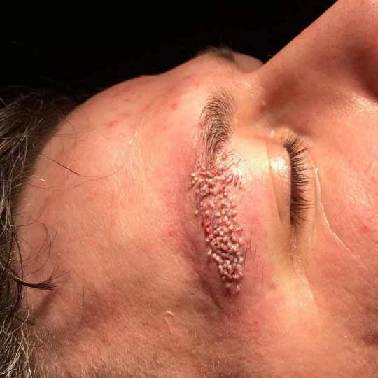 Eyebrow Transplantation