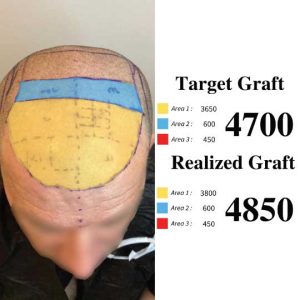 Hair Transplant Hairline