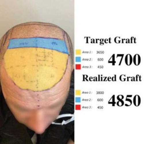 Hair Transplant Hairline