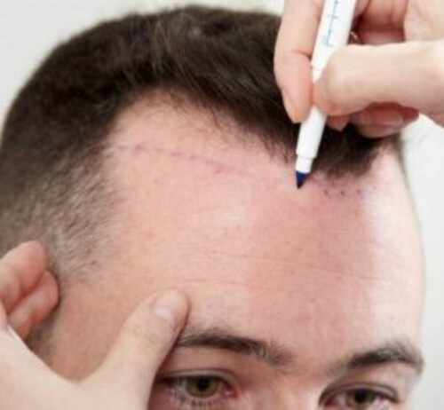 Curious About Hair Transplantation